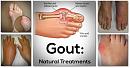 Click image for larger version

Name:	say-goodbye-to-gout-forever-with-this-powerful-natural-treatment-600x316.jpg
Views:	0
Size:	49.0 KB
ID:	773044